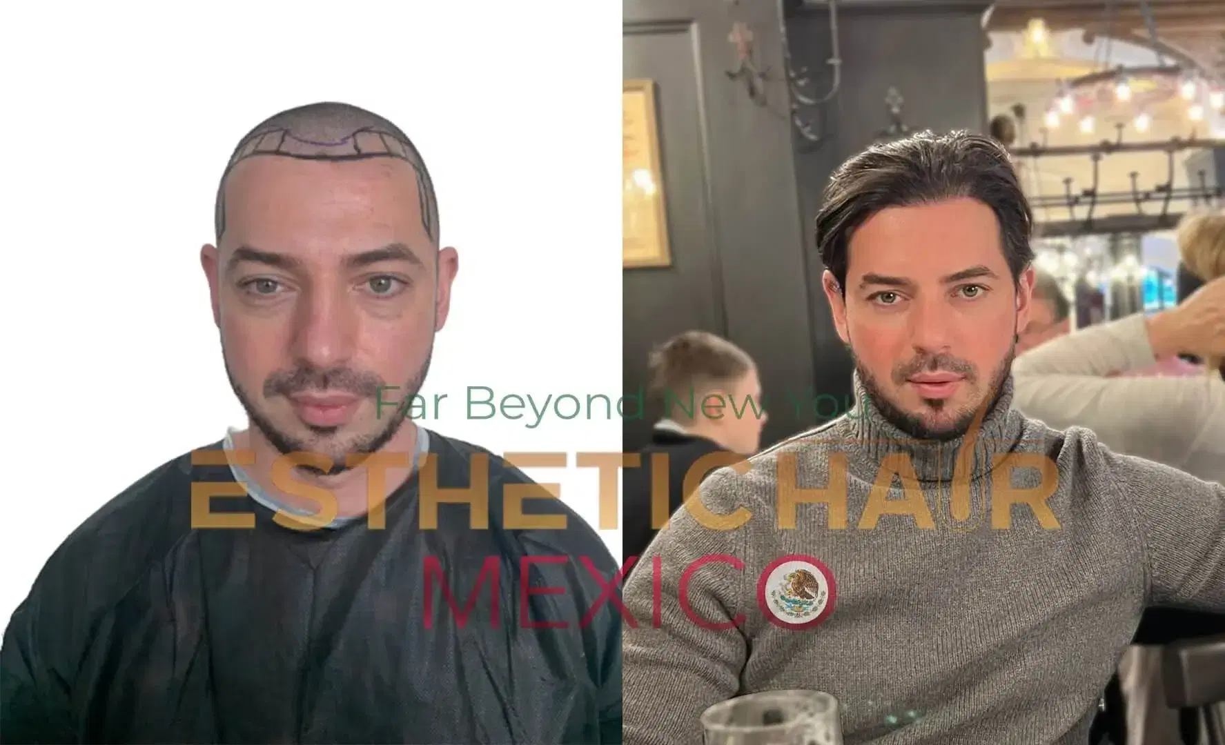 2000-grafts-hair-transplant