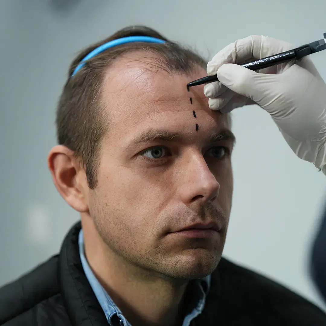 Antes del Trasplante Capilar