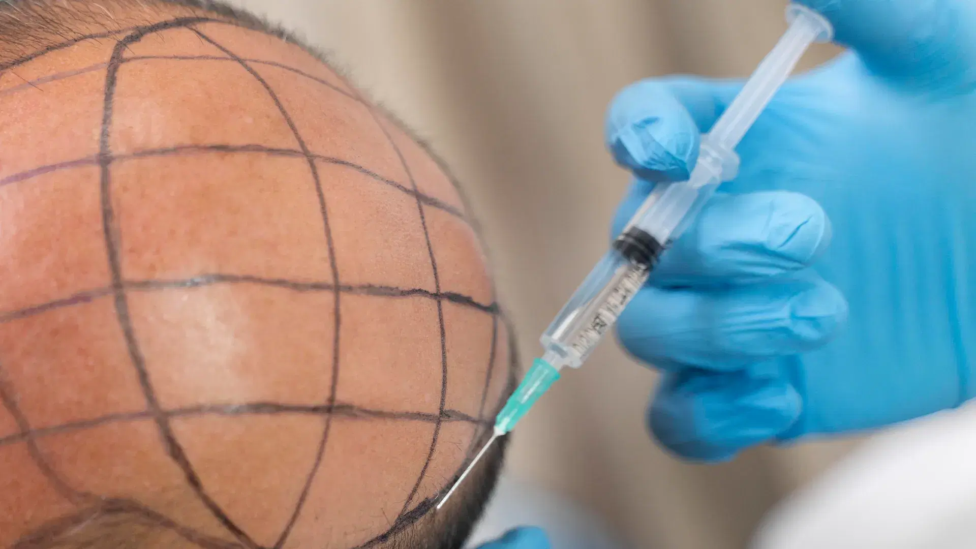 Stem Cell Therapy vs PRP Therapy