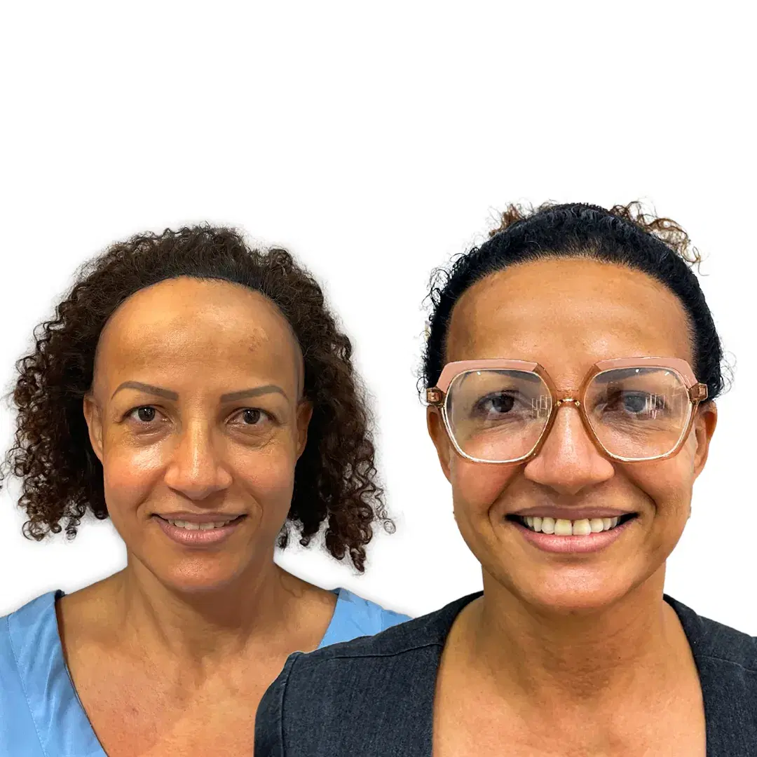 Trasplante Capilar Femenino