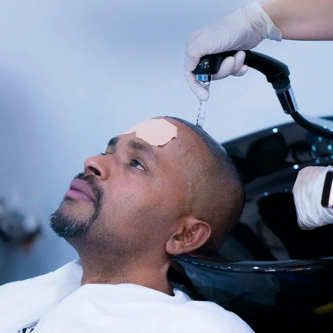 Lavado del Cabello Después del Trasplante Capilar