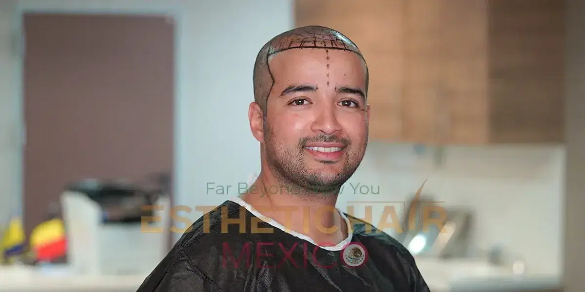 Hairline-Restoration-mexico