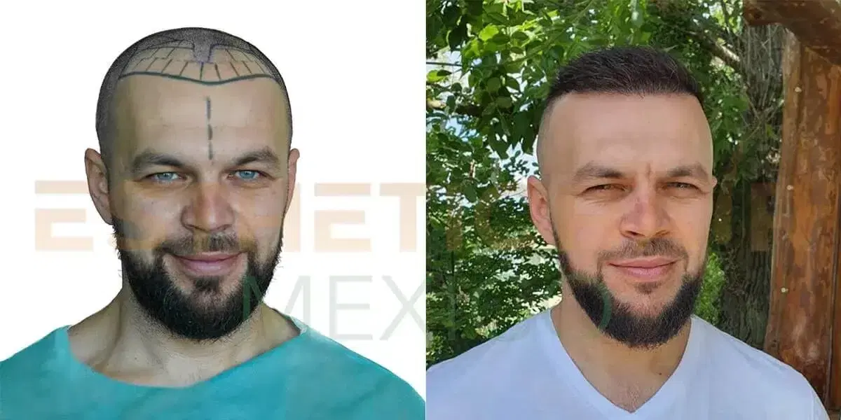 Permanent-hair-transplant
