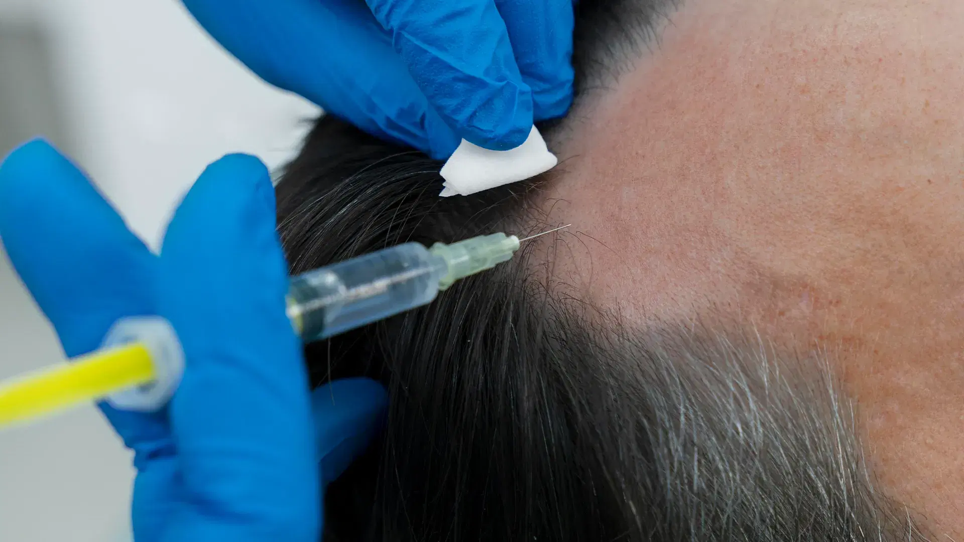 Stem Cell Therapy for Hair Loss
