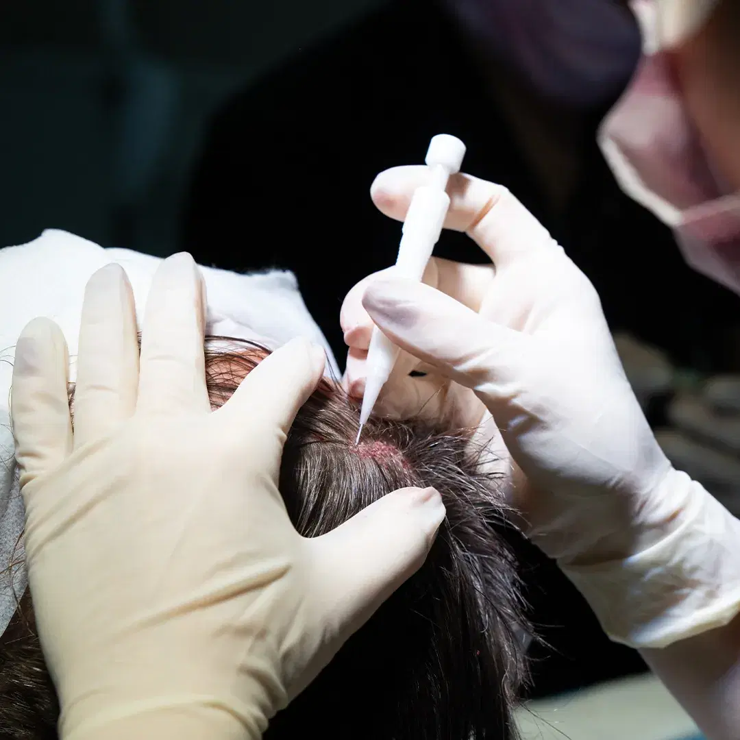 Trasplante Capilar Sin Rasurar