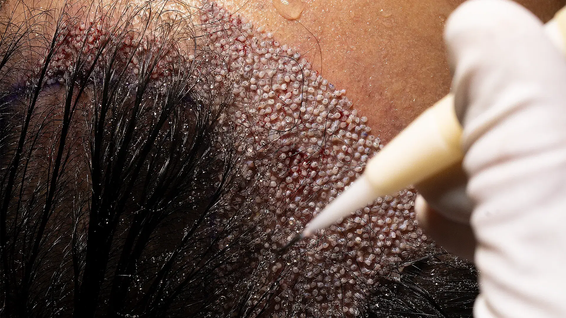 PRP Therapy vs Hair Transplant