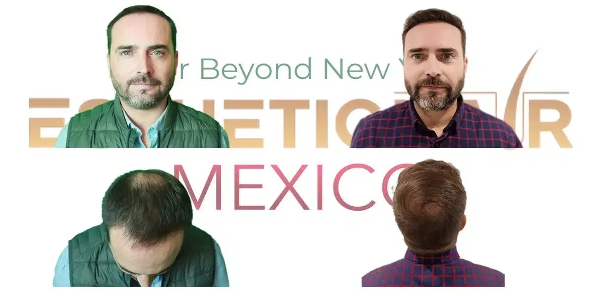 crown-hair-transplant