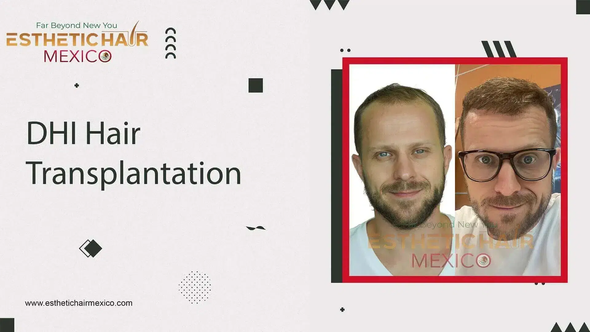 Trasplante Capilar DHI