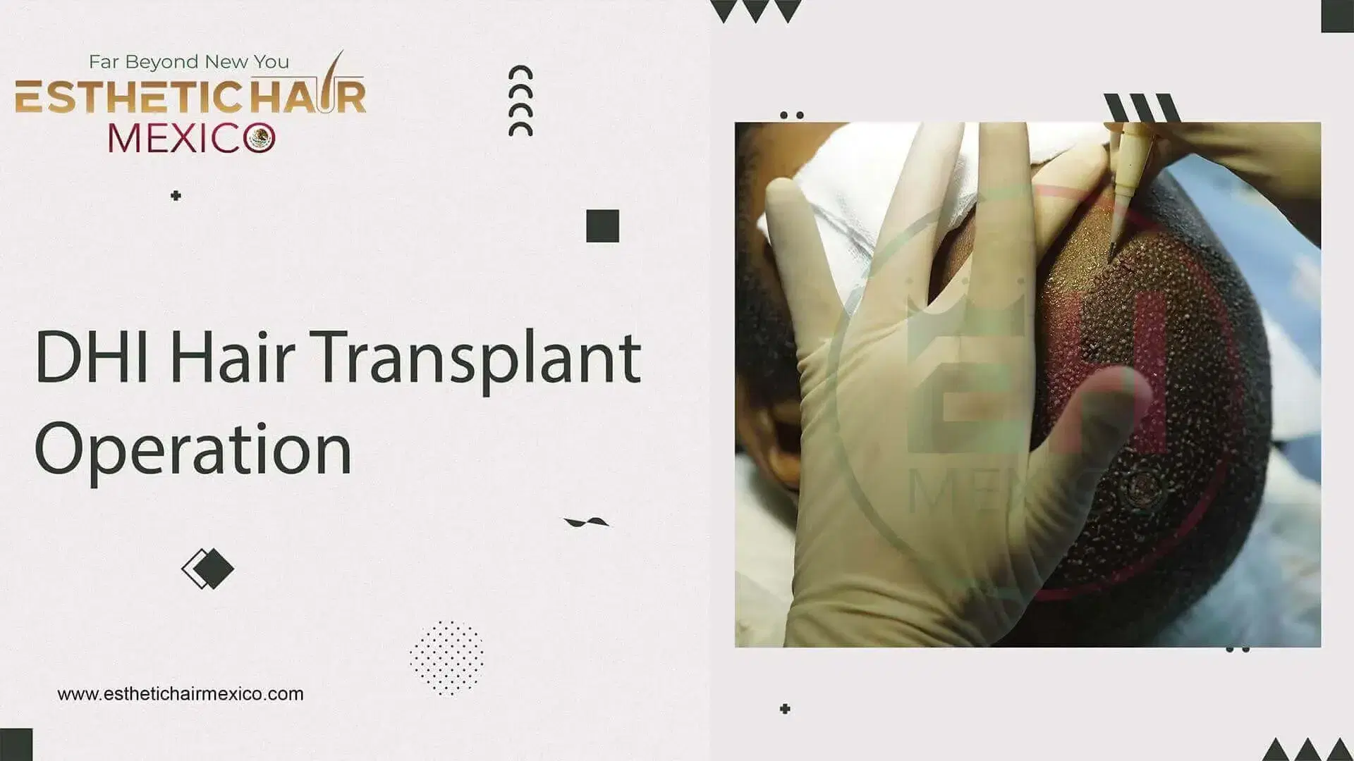 Trasplante Capilar DHI