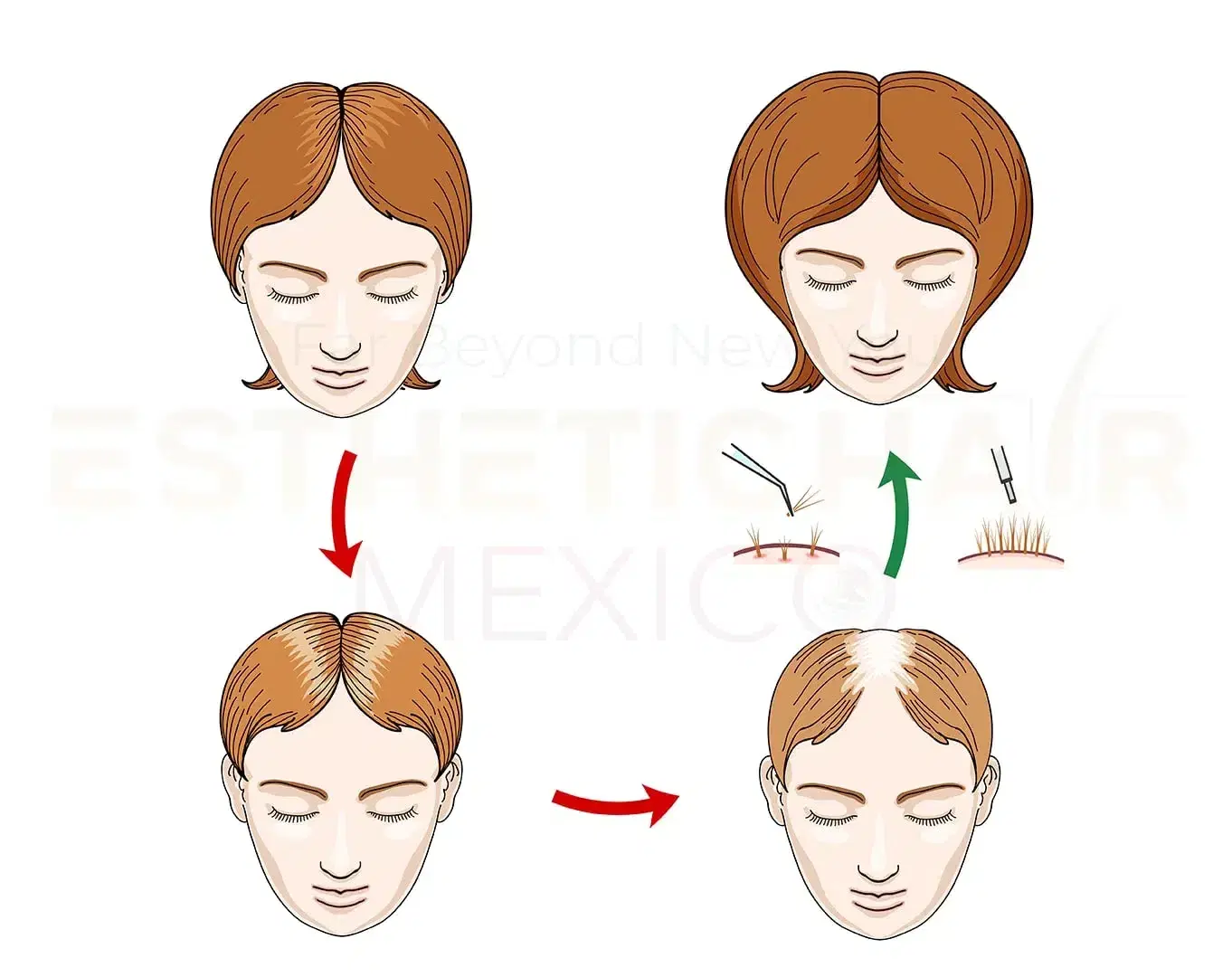 Trasplante Capilar DHI