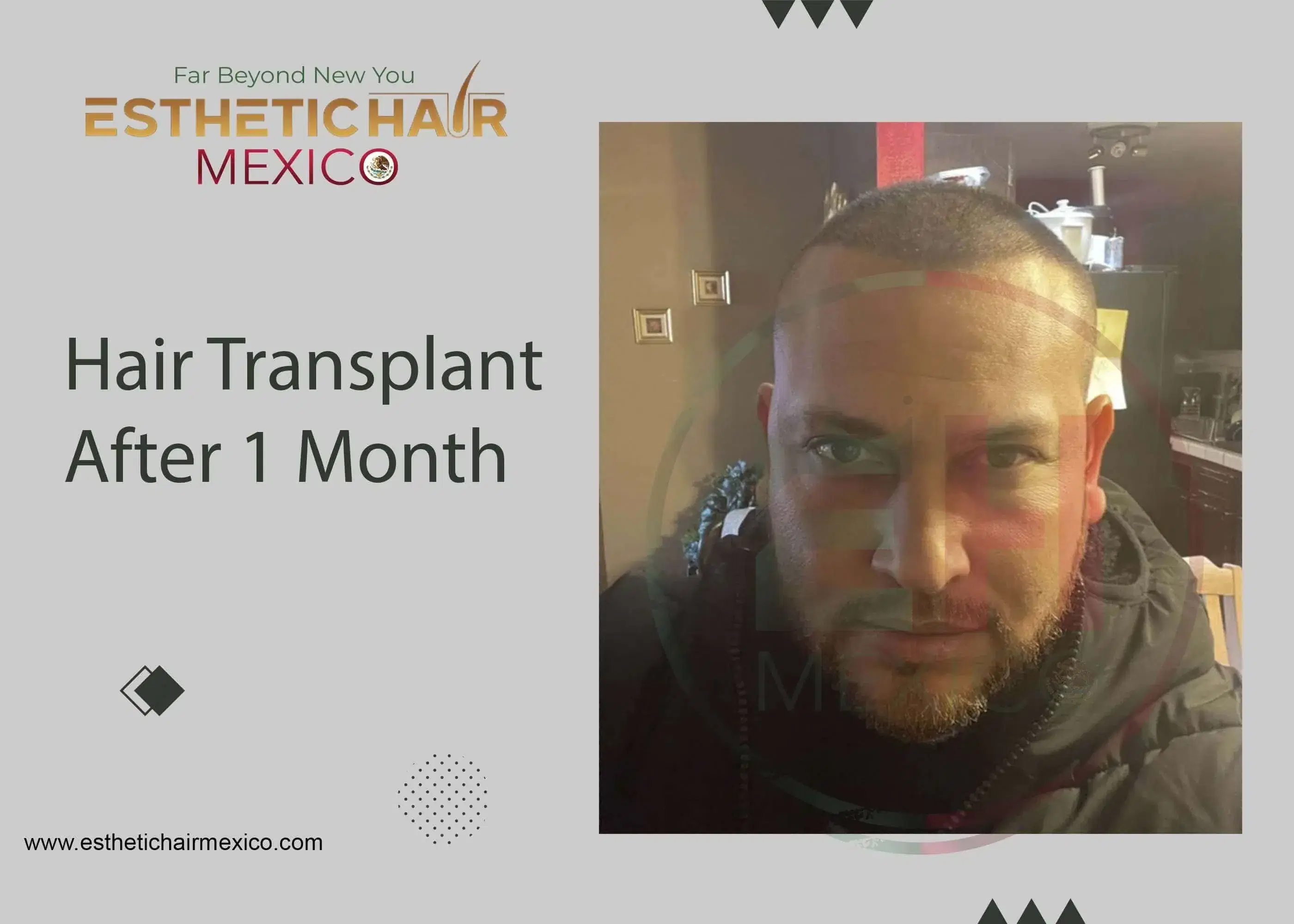 Trasplante Capilar DHI