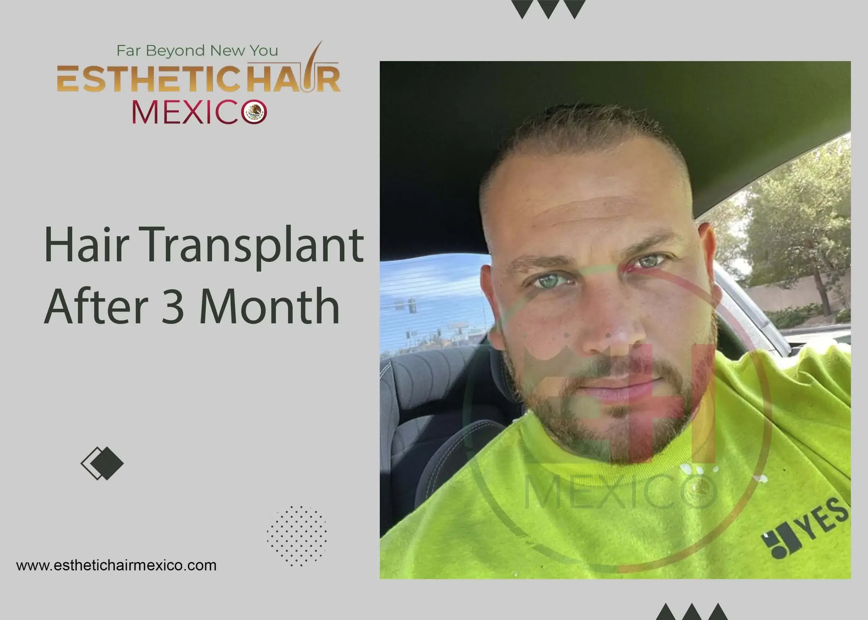 Trasplante Capilar DHI