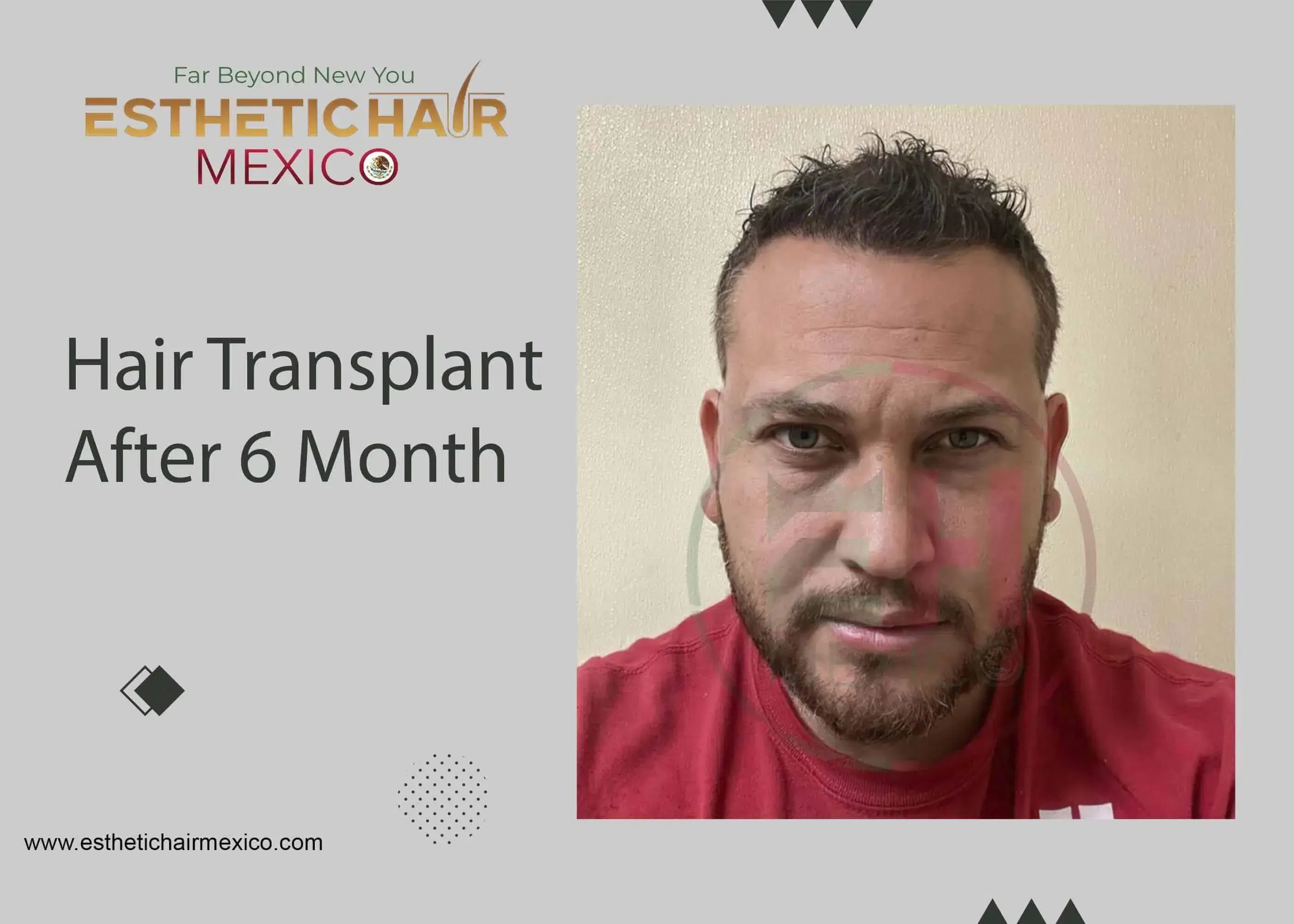 DHI Hair Transplant