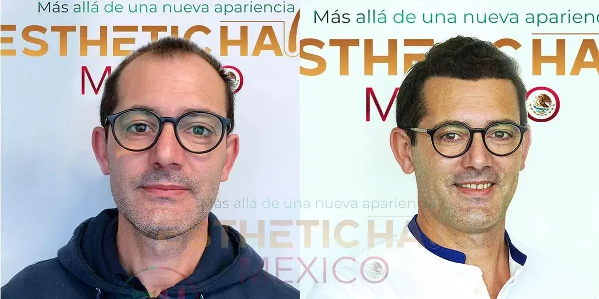 hair-transplant-cancun