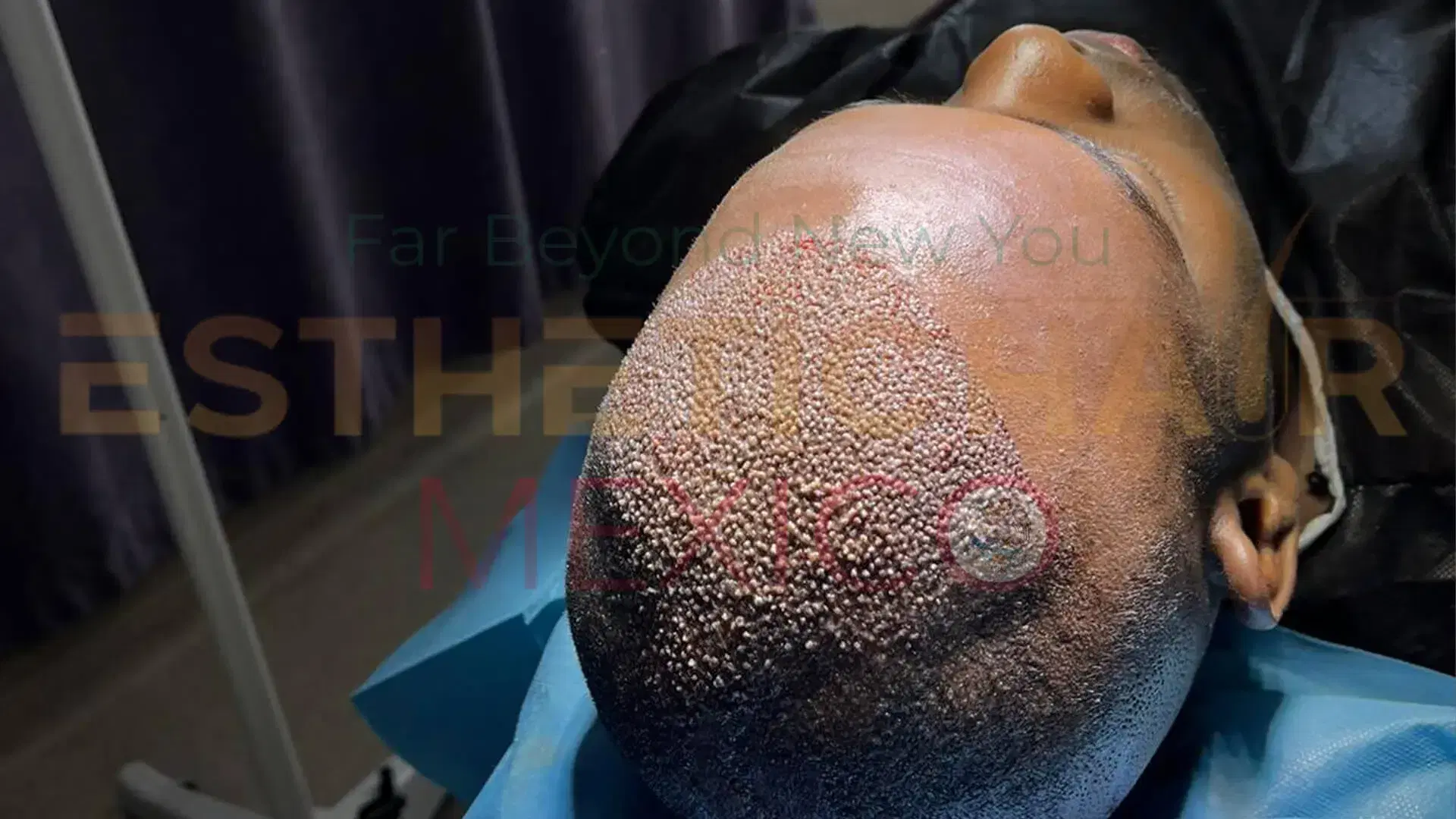 hair-transplant-crust