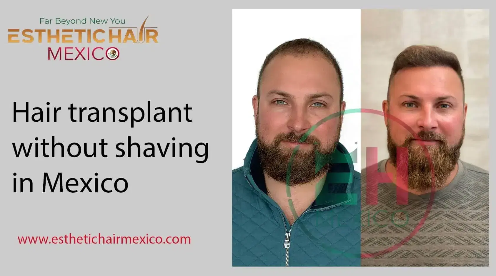 Trasplante Capilar DHI