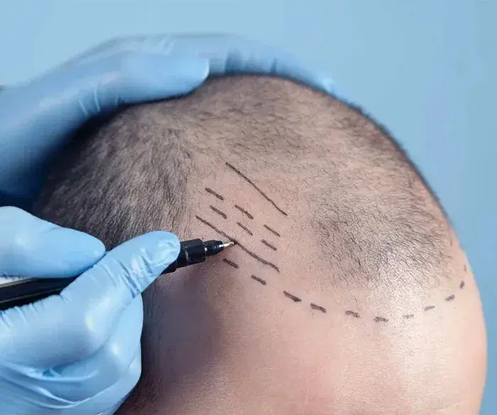 how-long-does-a-hair-transplant-take